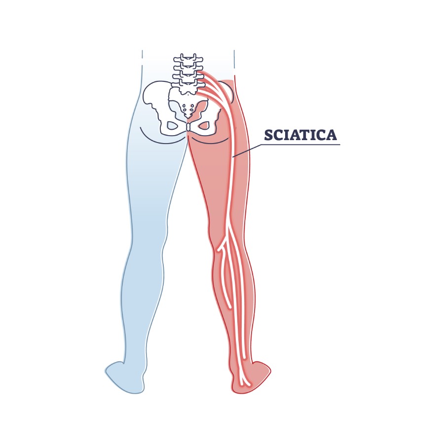 sciatica leg pain relief